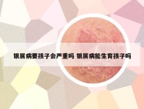 银屑病要孩子会严重吗 银屑病能生育孩子吗