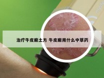 治疗牛皮廨土方 牛皮廨用什么中草药