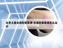 北京儿童水滴形银屑病 水滴型银屑病怎么治疗
