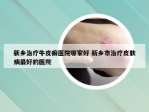新乡治疗牛皮癣医院哪家好 新乡市治疗皮肤病最好的医院