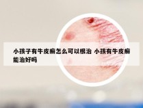 小孩子有牛皮癣怎么可以根治 小孩有牛皮癣能治好吗