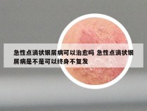 急性点滴状银屑病可以治愈吗 急性点滴状银屑病是不是可以终身不复发