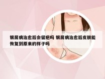 银屑病治愈后会留疤吗 银屑病治愈后皮肤能恢复到原来的样子吗