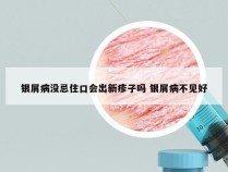 银屑病没忌住口会出新疹子吗 银屑病不见好