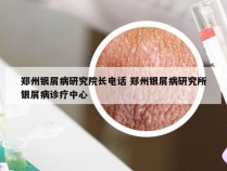 郑州银屑病研究院长电话 郑州银屑病研究所银屑病诊疗中心