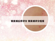 银屑病丘疹评分 银屑病评分程度