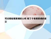 可以嫁给银屑病的人吗 嫁了个有银屑病的老公