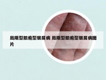 局限型脓疱型银屑病 局限型脓疱型银屑病图片