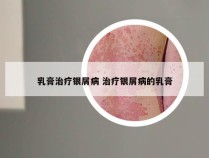 乳膏治疗银屑病 治疗银屑病的乳膏