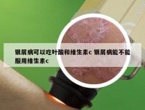 银屑病可以吃叶酸和维生素c 银屑病能不能服用维生素c
