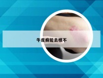 牛皮癣能去根不