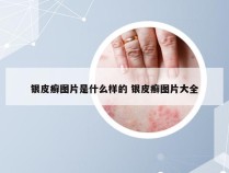 银皮癣图片是什么样的 银皮癣图片大全