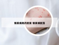 银屑病用药脱屑 银屑病脱落