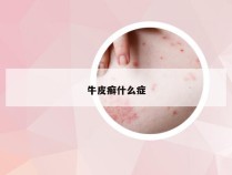 牛皮癣什么症