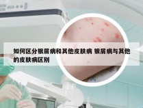 如何区分银屑病和其他皮肤病 银屑病与其他的皮肤病区别