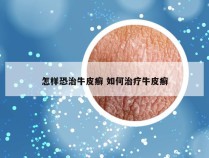 怎样恐治牛皮癣 如何治疗牛皮癣