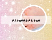 头发牛皮癣传染 头发 牛皮癣