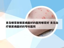 青岛哪家做银屑病最好的医院哪家好 青岛治疗银屑病最好的专科医院