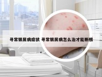 寻常银屑病症状 寻常银屑病怎么治才能断根