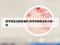 肤专家能治银屑病吗 肤专家银屑净多少钱一盒