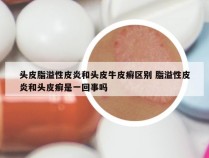 头皮脂溢性皮炎和头皮牛皮癣区别 脂溢性皮炎和头皮癣是一回事吗