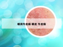 眼周牛皮癣 眼皮 牛皮癣