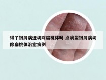 得了银屑病还切除扁桃体吗 点滴型银屑病切除扁桃体治愈病例