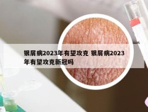 银屑病2023年有望攻克 银屑病2023年有望攻克新冠吗