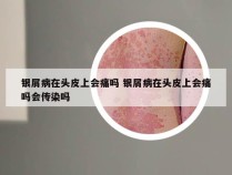 银屑病在头皮上会痛吗 银屑病在头皮上会痛吗会传染吗