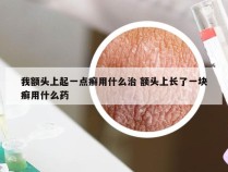 我额头上起一点癣用什么治 额头上长了一块癣用什么药