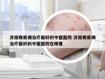济南银屑病治疗最好的中医医院 济南银屑病治疗最好的中医医院在哪里