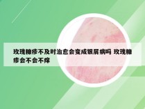 玫瑰糠疹不及时治愈会变成银屑病吗 玫瑰糠疹会不会不痒