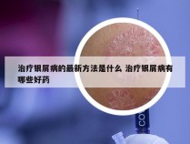 治疗银屑病的最新方法是什么 治疗银屑病有哪些好药