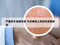 严重的牛皮癣淘宝 牛皮癣网上买的药膏敢用吗