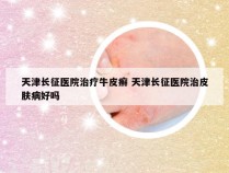 天津长征医院治疗牛皮癣 天津长征医院治皮肤病好吗