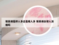 银屑病是胖人多还是瘦人多 银屑病会使人消瘦吗