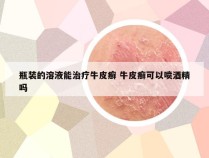 瓶装的溶液能治疗牛皮癣 牛皮癣可以喷酒精吗
