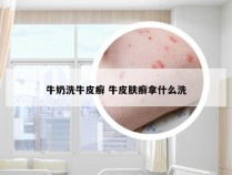 牛奶洗牛皮癣 牛皮肤癣拿什么洗