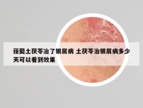 菝葜土茯苓冶了银屑病 土茯苓治银屑病多少天可以看到效果