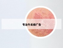 专治牛皮癣广告
