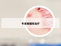 牛皮癣国际治疗