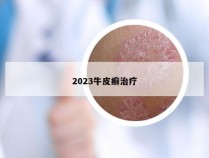 2023牛皮癣治疗