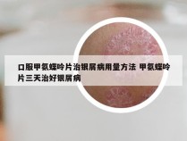 口服甲氨蝶呤片治银屑病用量方法 甲氨蝶呤片三天治好银屑病