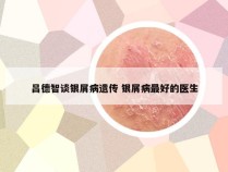 吕德智谈银屑病遗传 银屑病最好的医生