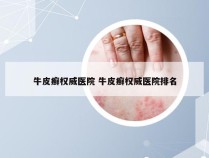 牛皮癣权威医院 牛皮癣权威医院排名