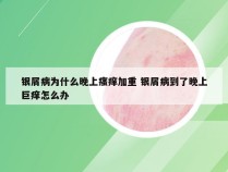 银屑病为什么晚上瘙痒加重 银屑病到了晚上巨痒怎么办