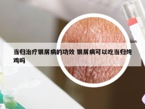 当归治疗银屑病的功效 银屑病可以吃当归炖鸡吗