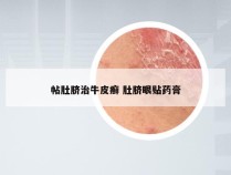 帖肚脐治牛皮癣 肚脐眼贴药膏