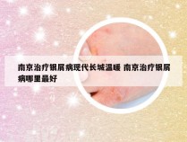南京治疗银屑病现代长城温暖 南京治疗银屑病哪里最好