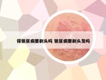 得银屑病要剃头吗 银屑病要剃头发吗